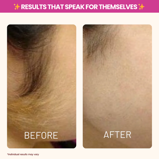 Cyperus Rotundus Oil - Natural Hair Removal & Moisturizing Oil