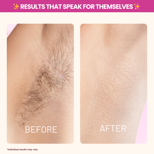 Cyperus Rotundus Oil - Natural Hair Removal & Moisturizing Oil