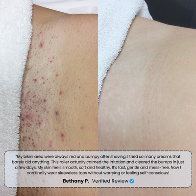 Banex | Ingrown Hair Treatment Serum