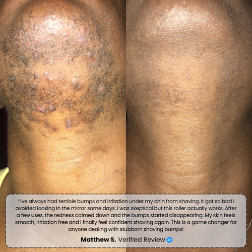 Banex | Ingrown Hair Treatment Serum