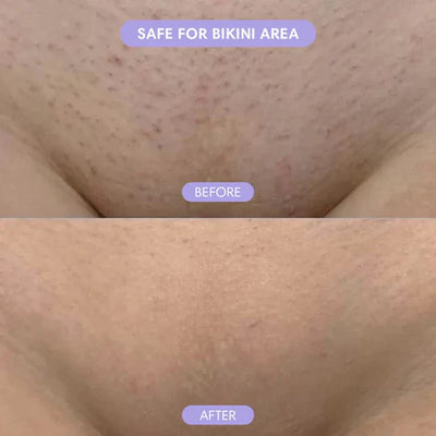 Hair Removal Spray