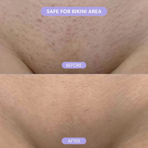 Hair Removal Spray